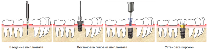 Имплантация зубов